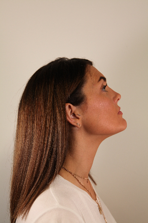 neck rejuvenation example